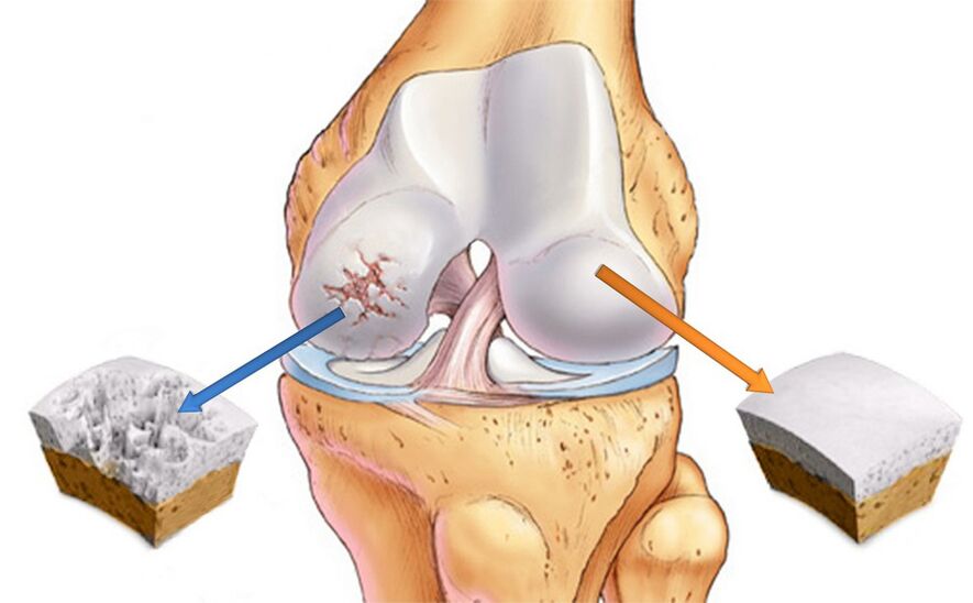 Knee arthrosis