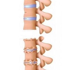 Stages of ramps of osteochondrosis of the neck