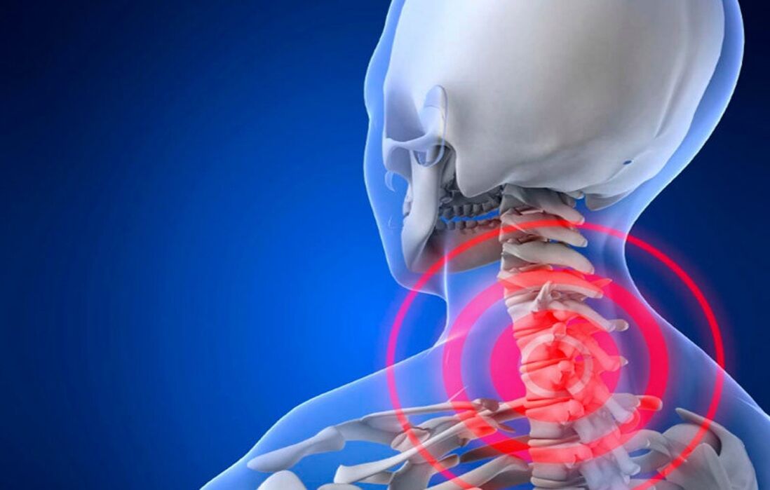 osteochondrosis of the cervical vertebrae